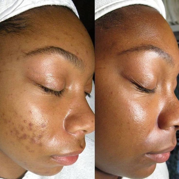 Grade 1 acne before and after