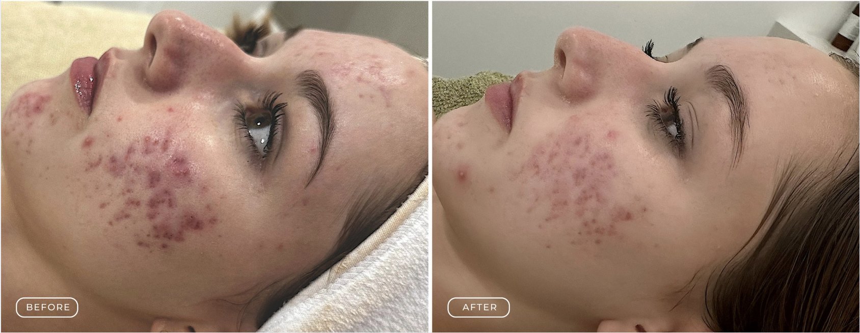 Grade 2 acne before and after