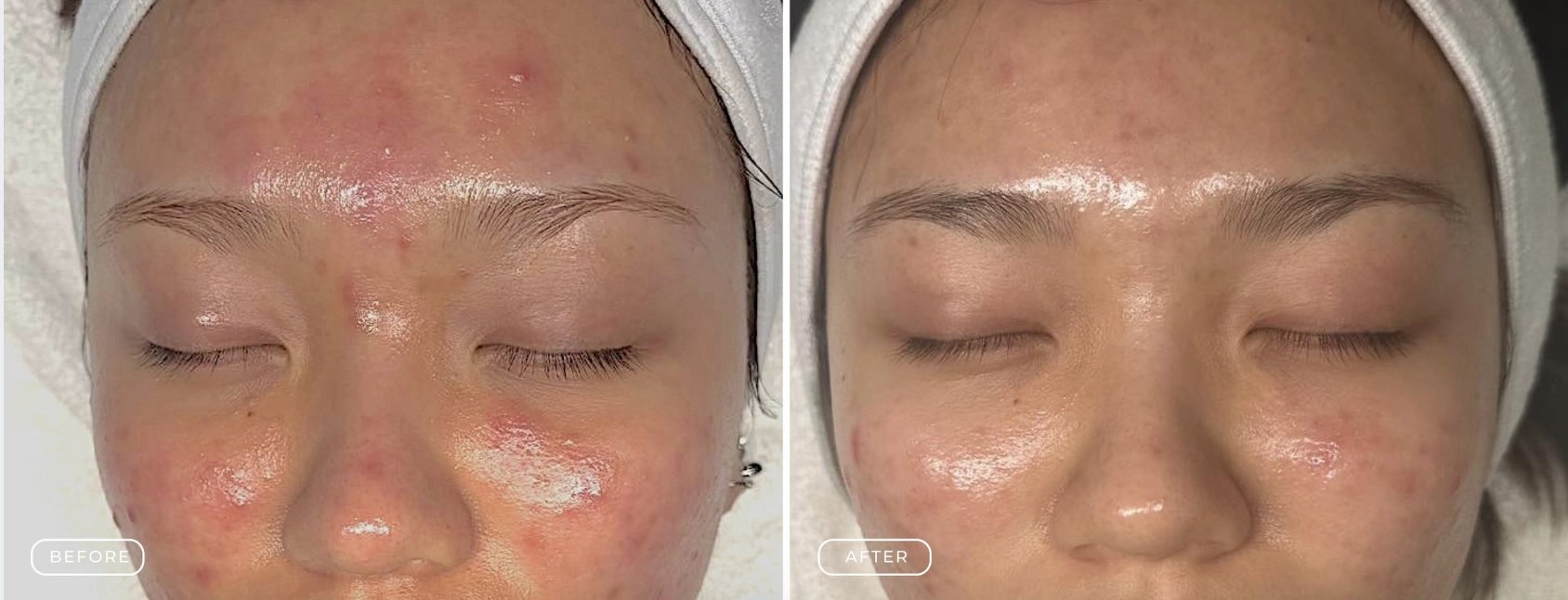 Grade 2 acne before and after