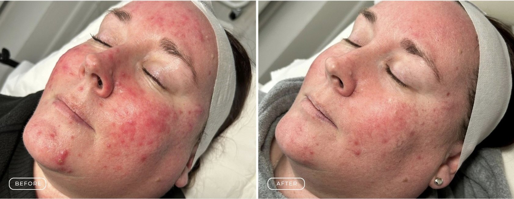 Grade 3 acne before and after