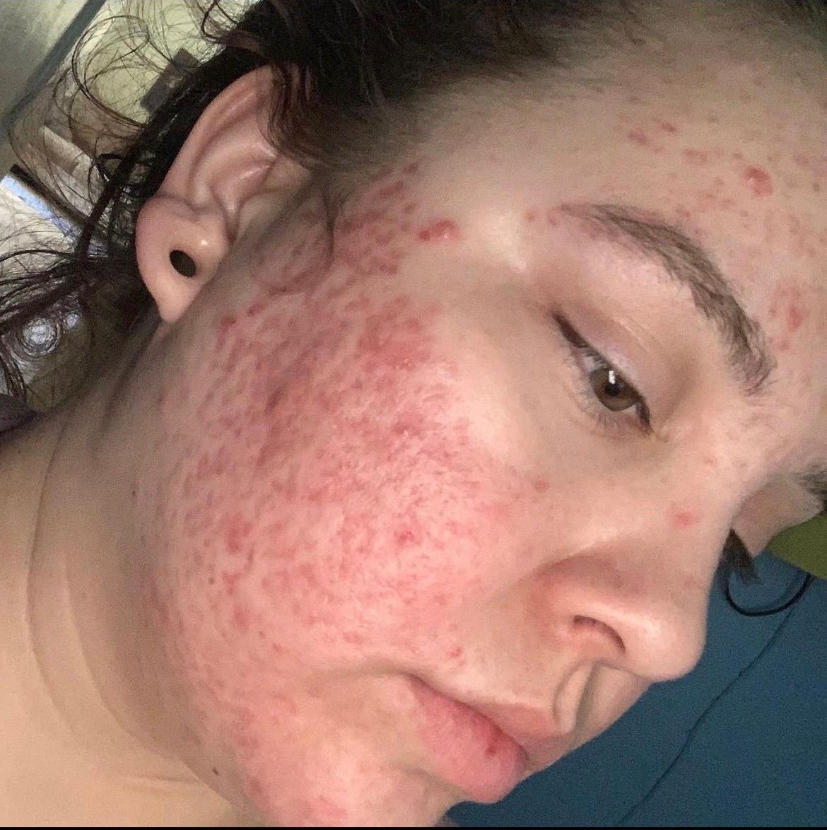 Acne progress